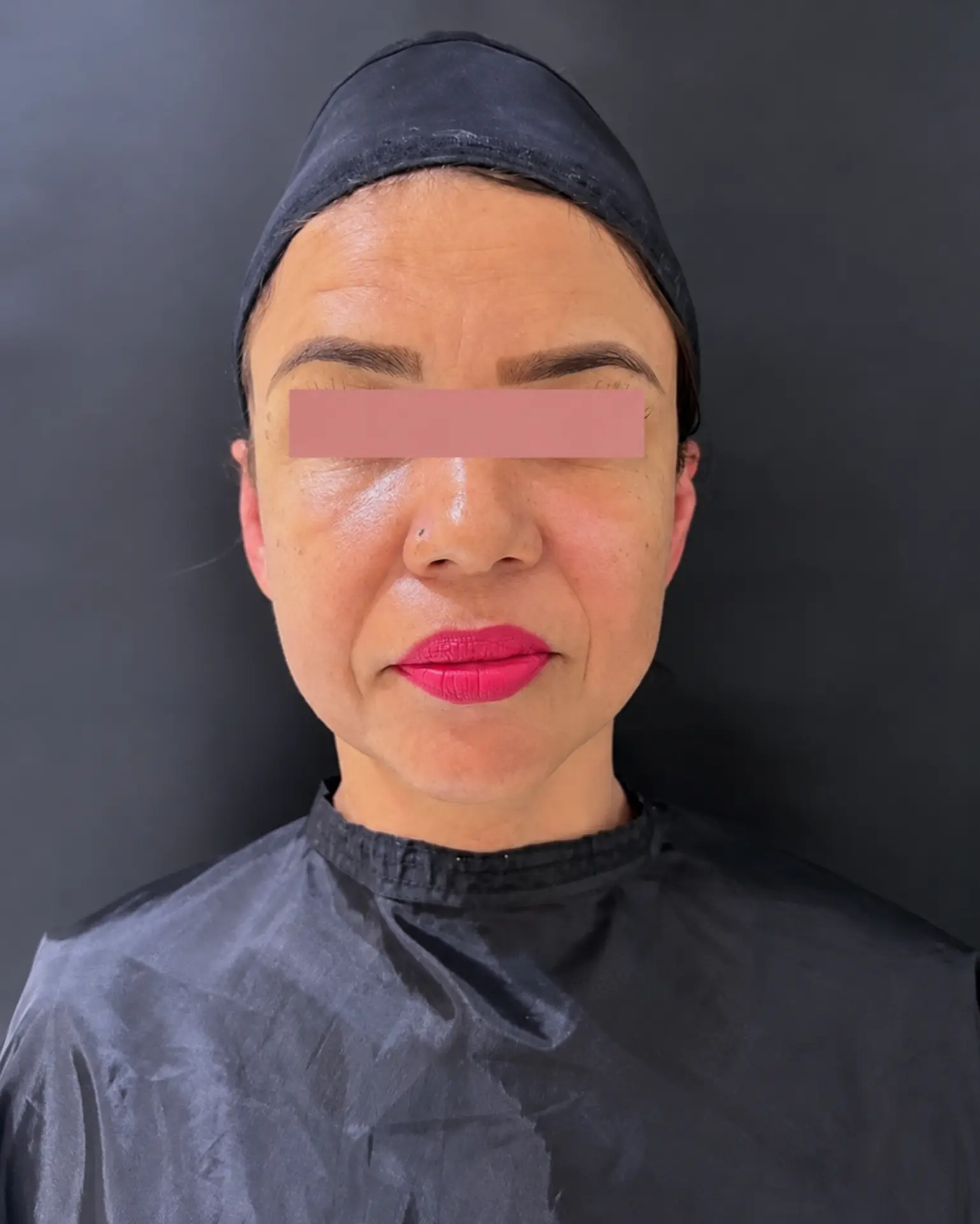 Depois da otoplastia